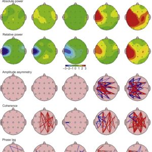 نقشه مغزی QEEG